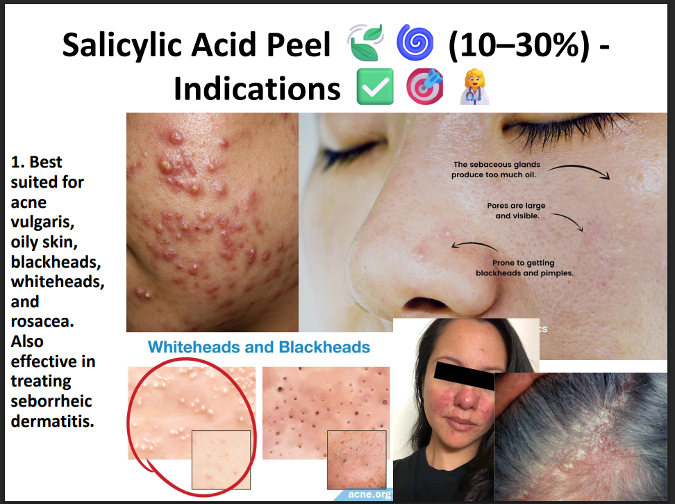 Salicylic Acid Peeling Solution 30% – Professional BHA Chemical Peel for Acne, Oily Skin, Blackheads & Pore Cleansing