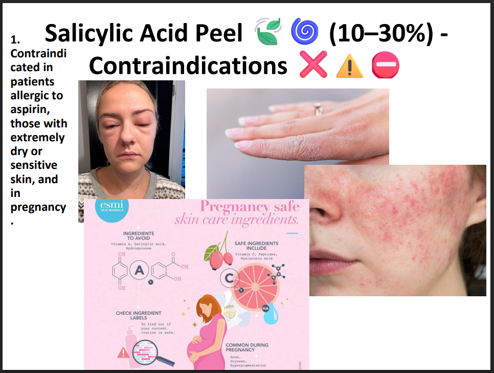 Salicylic Acid Peeling Solution 30% – Professional BHA Chemical Peel for Acne, Oily Skin, Blackheads & Pore Cleansing
