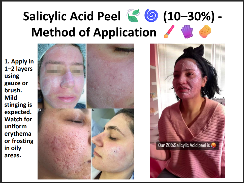 Salicylic Acid Peeling Solution 30% – Professional BHA Chemical Peel for Acne, Oily Skin, Blackheads & Pore Cleansing