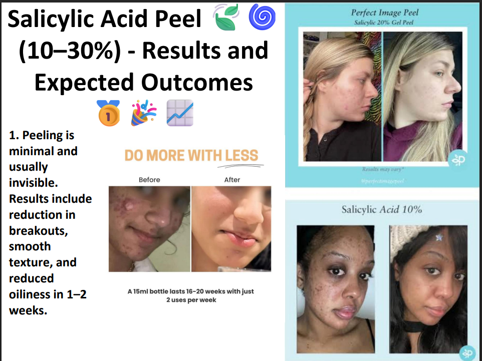 Salicylic Acid Peeling Solution 30% – Professional BHA Chemical Peel for Acne, Oily Skin, Blackheads & Pore Cleansing