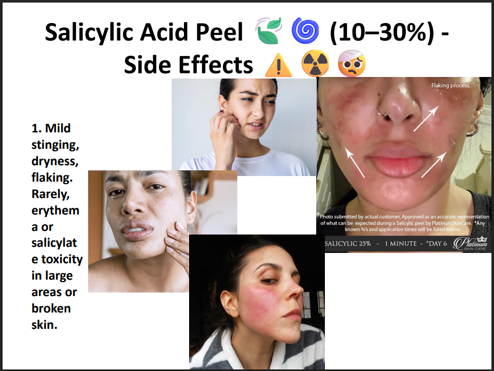 Salicylic Acid Peeling Solution 30% – Professional BHA Chemical Peel for Acne, Oily Skin, Blackheads & Pore Cleansing