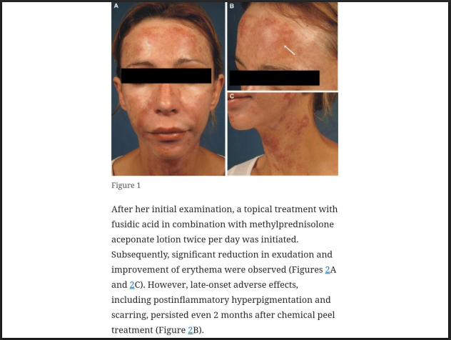 Glycolic Acid Peeling Solution 75% – Professional AHA Chemical Peel for Deep Exfoliation, Pigmentation, Acne Marks & Skin Resurfacing