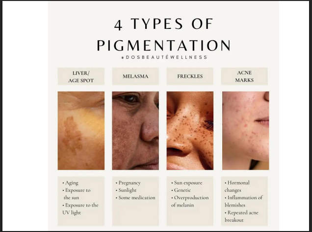 Jessner’s Peeling Solution (14% SA + 14% LA + 14% Resorcinol) – Professional Combination Chemical Peel for Acne, Pigmentation & Skin Resurfacing