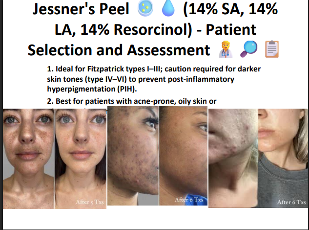 Jessner’s Peeling Solution (14% SA + 14% LA + 14% Resorcinol) – Professional Combination Chemical Peel for Acne, Pigmentation & Skin Resurfacing