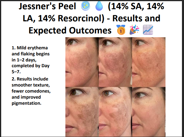 Jessner’s Peeling Solution (14% SA + 14% LA + 14% Resorcinol) – Professional Combination Chemical Peel for Acne, Pigmentation & Skin Resurfacing