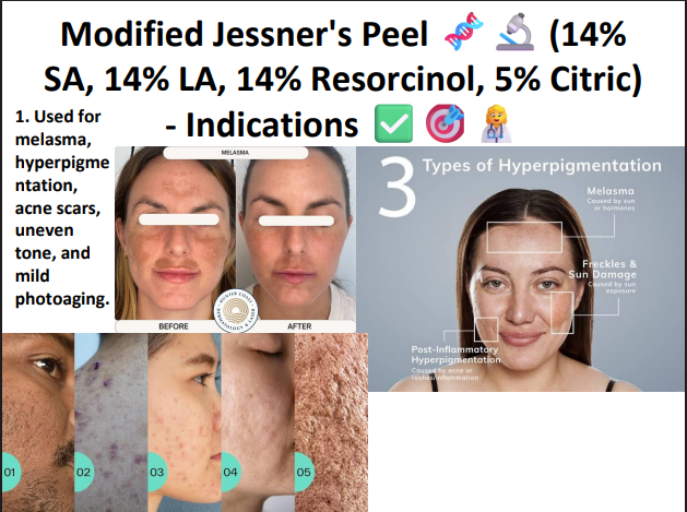 Modified Jessner’s Peeling Solution (14% SA + 14% LA + 14% Resorcinol + 5% Citric Acid) – Professional Peel for Pigmentation, Acne Marks & Brightening