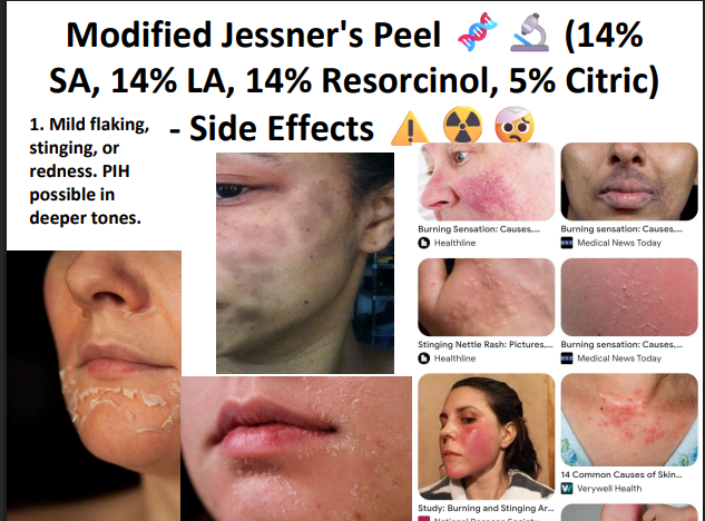 Modified Jessner’s Peeling Solution (14% SA + 14% LA + 14% Resorcinol + 5% Citric Acid) – Professional Peel for Pigmentation, Acne Marks & Brightening