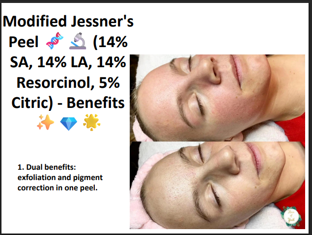 Modified Jessner’s Peeling Solution (14% SA + 14% LA + 14% Resorcinol + 5% Citric Acid) – Professional Peel for Pigmentation, Acne Marks & Brightening
