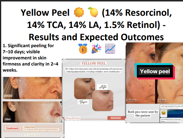 yellow peel (14% resorcinol,14% tca ,114% ls 1.5 Retinol)
