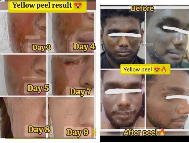 yellow peel (14% resorcinol,14% tca ,114% ls 1.5 Retinol)