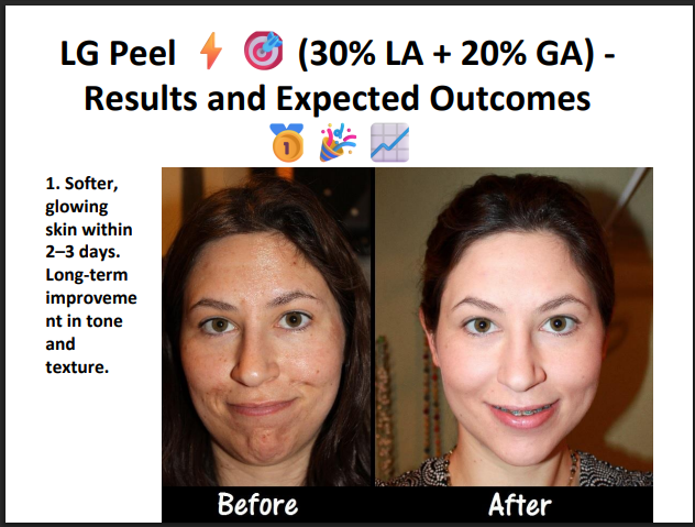 LG Peel (30% Lactic Acid + 20% Glycolic Acid) – Professional Hydrating & Exfoliating Chemical Peel for Glow, Texture & Uneven Skin Tone