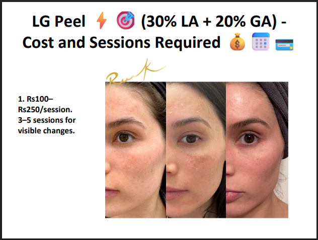 LG Peel (30% Lactic Acid + 20% Glycolic Acid) – Professional Hydrating & Exfoliating Chemical Peel for Glow, Texture & Uneven Skin Tone