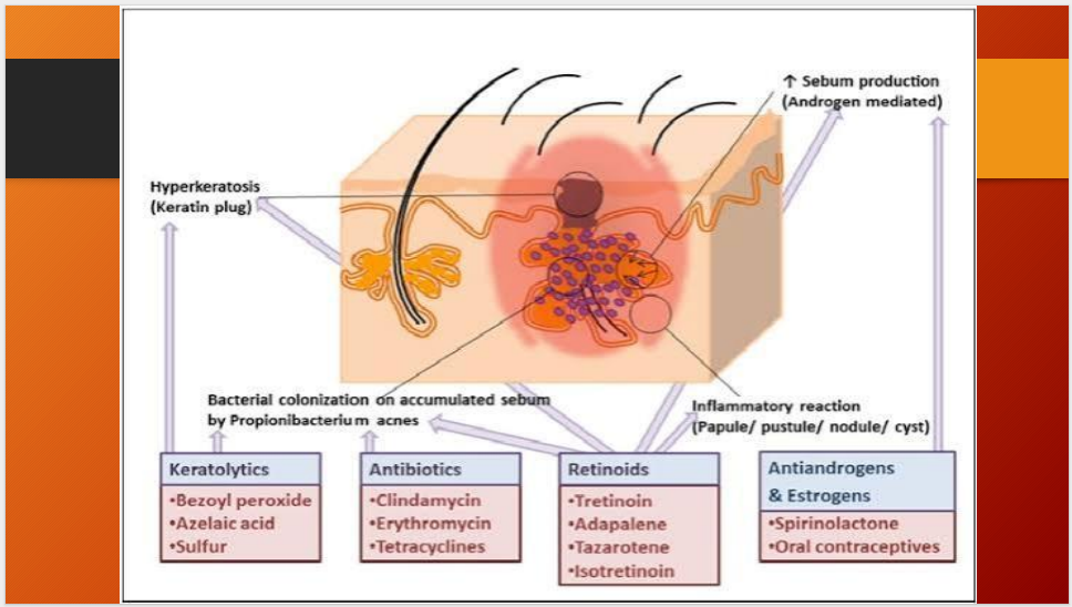 Klinda Compound Lotion (3% Sulfur + 1% Clindamycin) – Anti Acne Lotion for Pimples, Oily Skin, Breakouts & Blemishes (30ml)