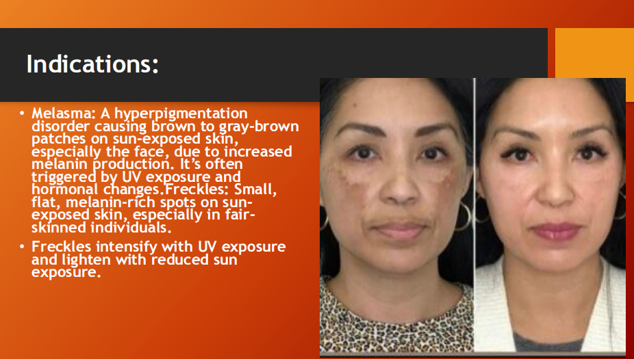 Melakoj Fort Cream – Melasma & Freckles Treatment (15g)
