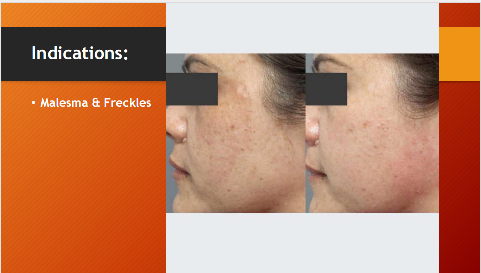 Melacure Cream – Melasma & Freckles Treatment (15g)