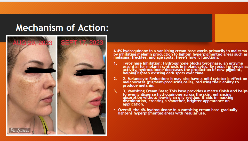 Melasma Cream 4% – Hydroquinone Depigmenting Treatment (15g)