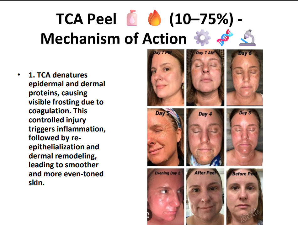 TCA Peeling Solution 75% – Professional Grade Chemical Peel for Deep Exfoliation, Skin Resurfacing & Pigmentation