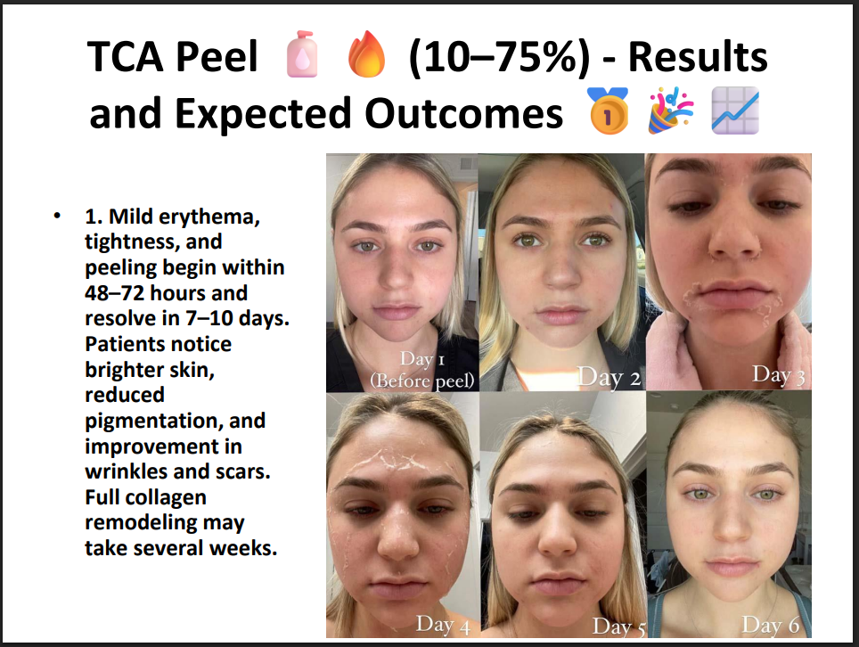 TCA Peeling Solution 75% – Professional Grade Chemical Peel for Deep Exfoliation, Skin Resurfacing & Pigmentation
