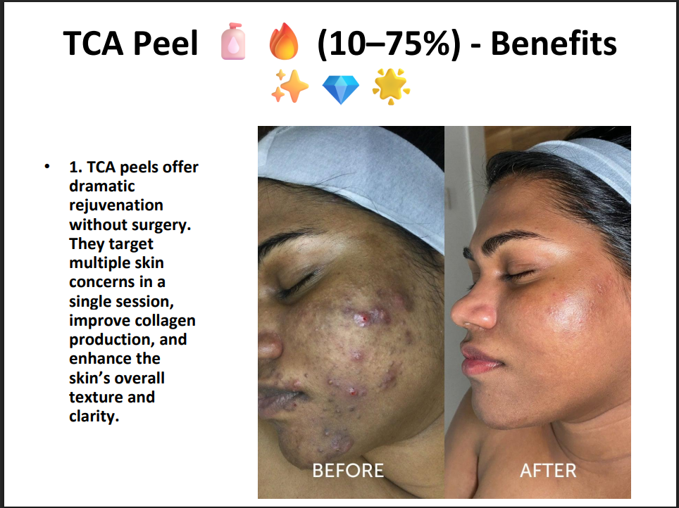 TCA Peeling Solution 75% – Professional Grade Chemical Peel for Deep Exfoliation, Skin Resurfacing & Pigmentation