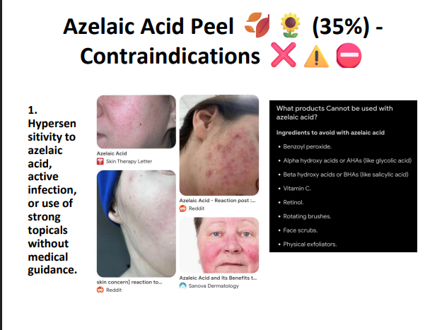 Azelaic Acid Peeling Solution 35% – Professional Peel for Acne, Sensitive Skin, Redness & Pigmentation Correction
