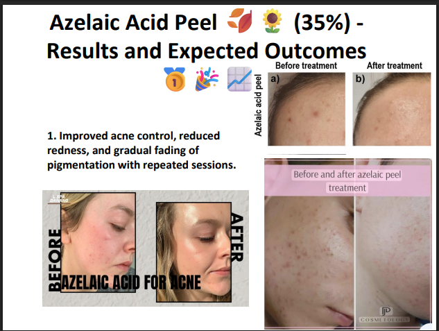 Azelaic Acid Peeling Solution 35% – Professional Peel for Acne, Sensitive Skin, Redness & Pigmentation Correction