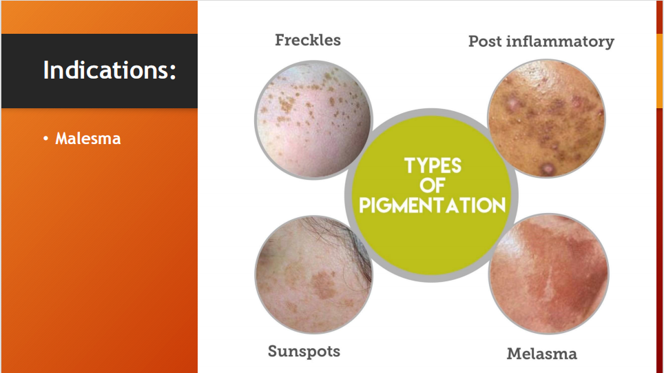 2% Melasma Cream – Hydroquinone 2% Vanishing Cream (15g)